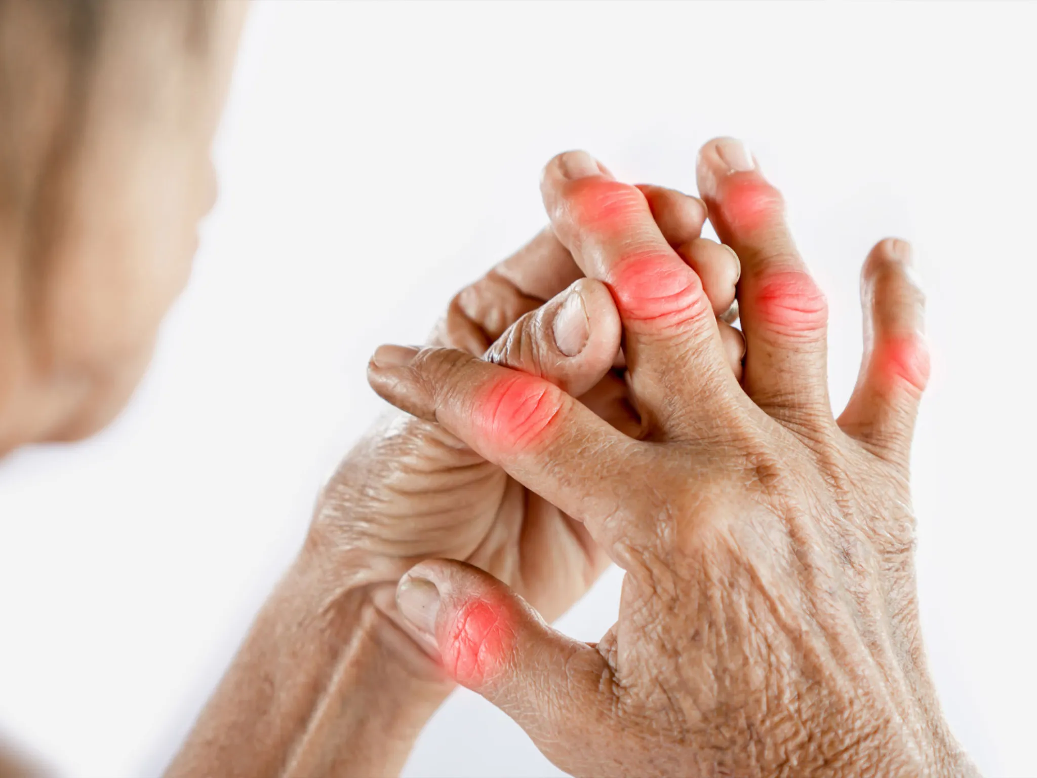 Arthritis Treatment